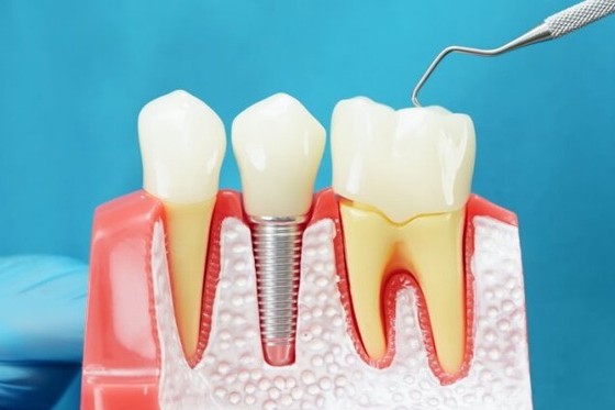 2implantes
