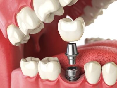 nuestro equipo de profesionales qué son los implantes dentales