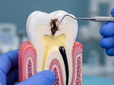 Es Mejor Una Endodoncia O Quitar El Diente Img437534t1 1