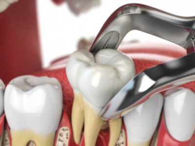 extracciones dentales complejas